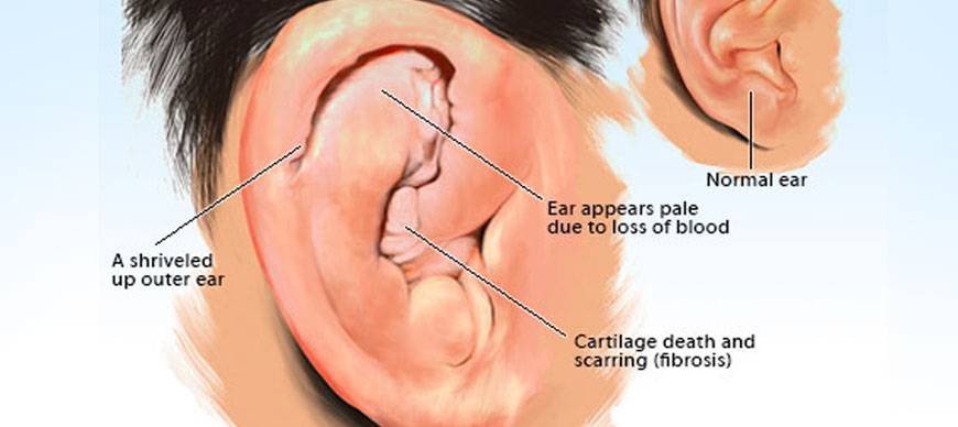 Hình ảnh mô tả diễn biến chèn ép ở tình trạng tai súp lơ